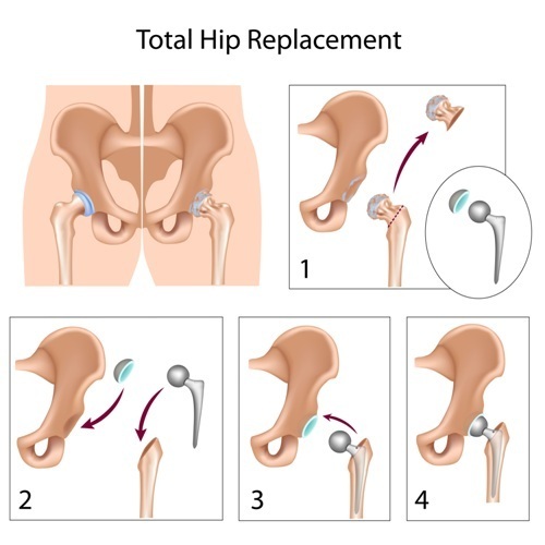 Hip Implants Dubai
