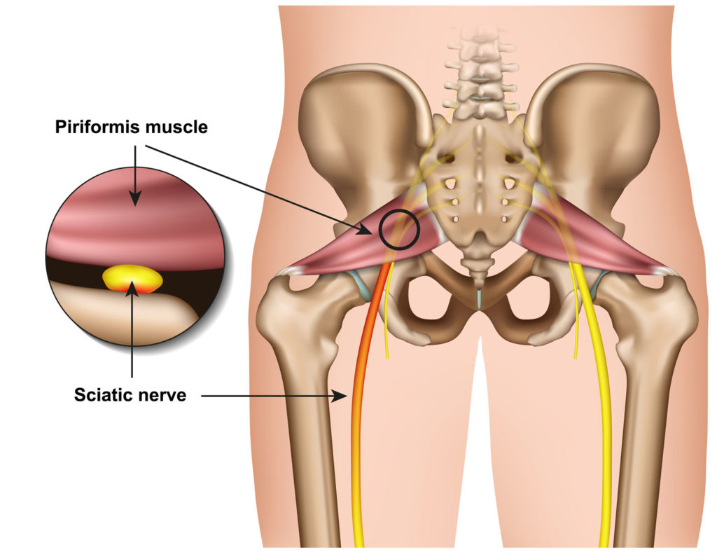 Nonsurgical Decompression Therapy For Piriformis Syndrome - El