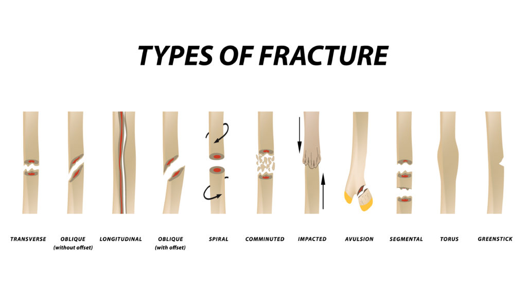 type of fracture 