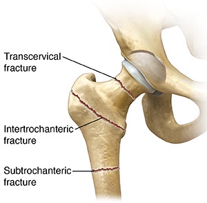 Front view of hip joint showing three types of hip fractures